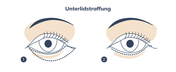 Grafik Unterlidstraffung, Plastische und Ästhetische Chirurgie Reutlingen, Prof. Dr. med. Manuel Held