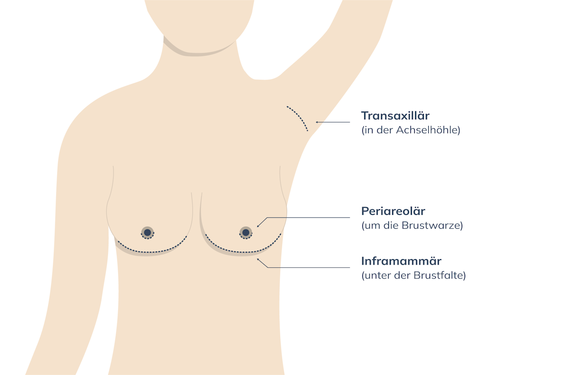 Grafik Zugangswege Brustimplantat, Plastische und Ästhetische Chirurgie Reutlingen, Prof. Dr. med. Manuel Held