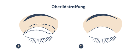Grafik Oberlidstraffung, Plastische und Ästhetische Chirurgie Reutlingen, Prof. Dr. med. Manuel Held